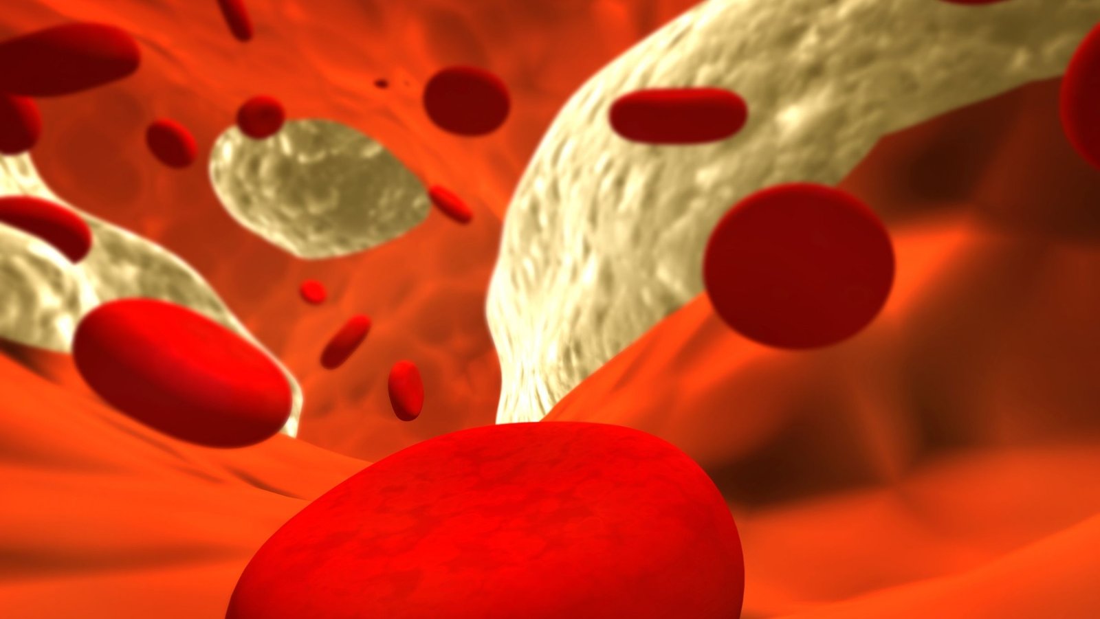 ¿Qué es la aterosclerosis?