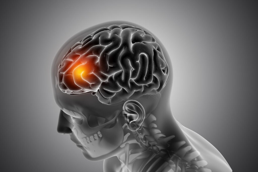 Cáncer cerebral en adultos: la importancia de reconocer a tiempo las señales que el cuerpo envía